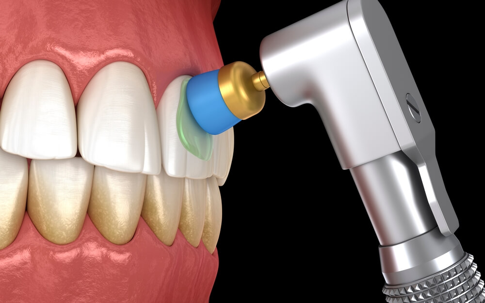 Exploring the Latest Trends in Teeth Whitening Technology